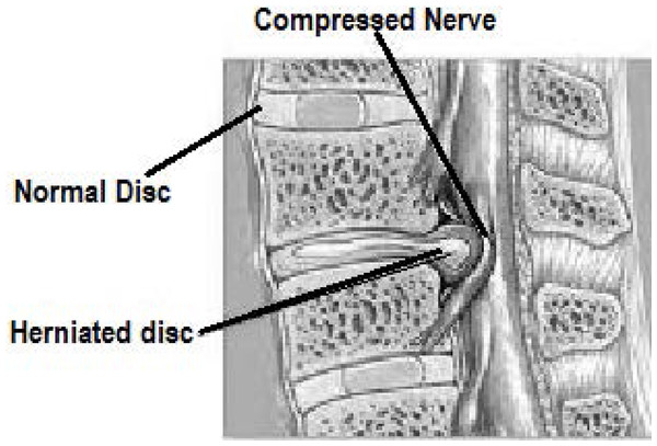 Image showing the disc herniation problem. Due to herniated disc the nerve is compressed.