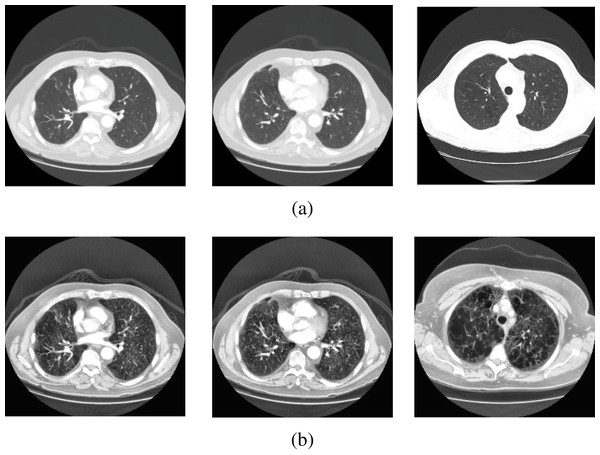Sample scans from the dataset before and after enhancement showing healthy lungs.
