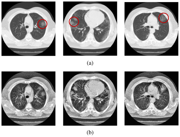 Sample scans from the dataset before and after enhancement showing infected lungs.