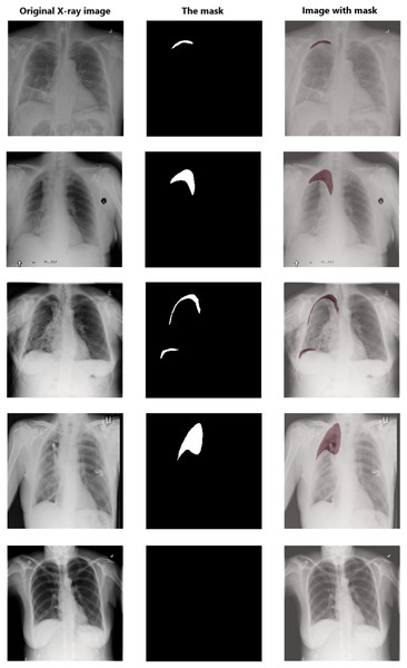 Examples of some X-ray images (left), the masks (middle), and the X-ray images with masks (right).