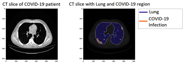 A sample of the COVID-19 segmentation dataset.