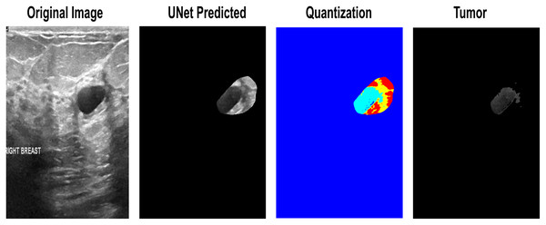 The quantization-based re-segmented tumor. 1. Input Image. 2. Imprecise Prediction of U-Net. 3. Quantization. 4. Isolation of the exact lesion area.