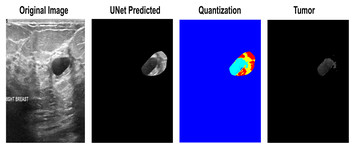 A Quantization Assisted U-Net Study With ICA And Deep Features Fusion ...