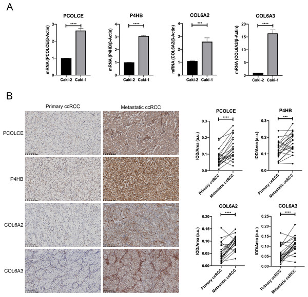 Expression of key genes in primary ccRCC and the corresponding metastatic ccRCC.