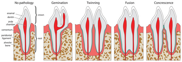 Idealized expressions of double tooth pathologies of stylized mammalian incisor teeth in lingual view.