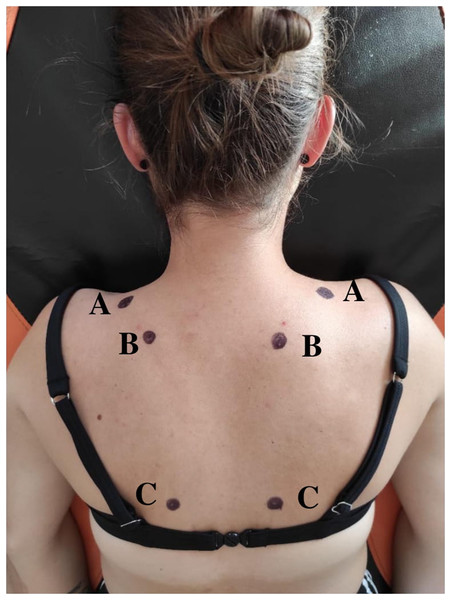 Location of trigger points on the right and left side of the neck and shoulder.
