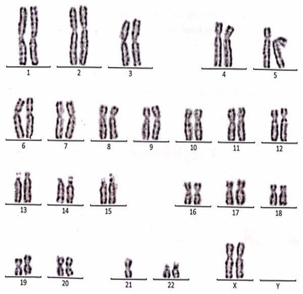 Karyotype of the female with 45, XX, t (21; 21).