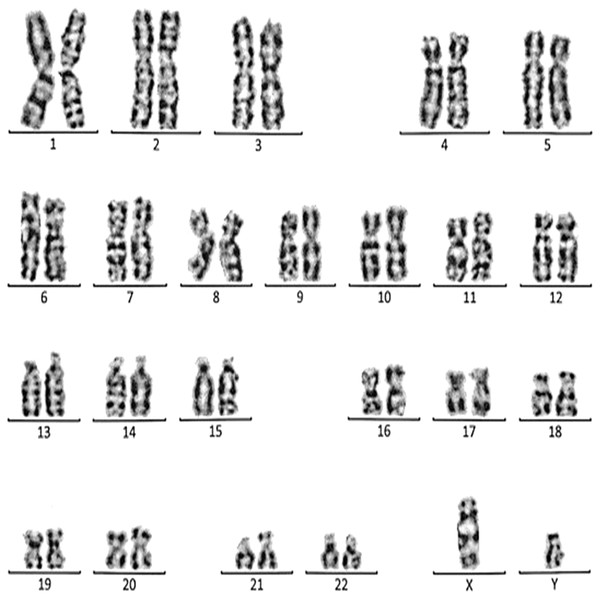 Karyotype of the male with 46, XY, add (21)(p13).