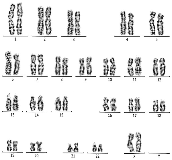 Karyotype of the female with 46, XX, add (21)(p13).