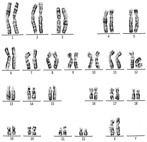 Karyotype of the female with 46, XX, 21ps+.