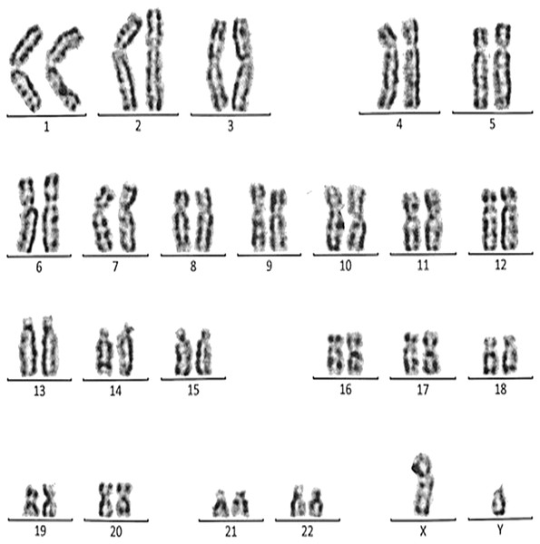 Karyotype of the male with 46, XY, per inv (9) (p11q12).