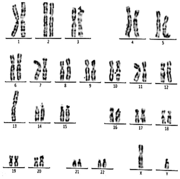 Karyotype of the male with 45, XY, t (13q, 13q).
