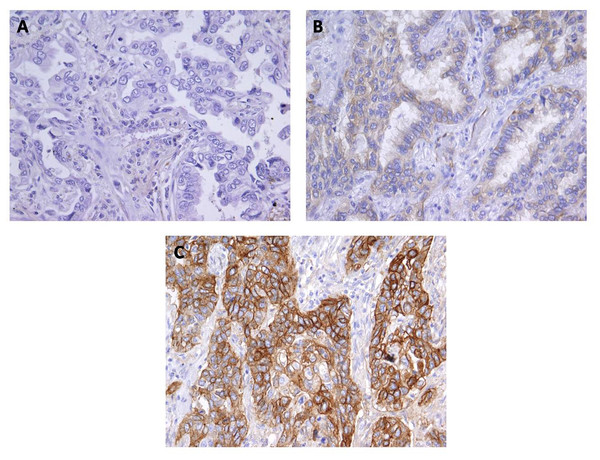Immunohistochemical staining for Cx43 showing no expression (A) and low expression (B) in lung adenocarcinoma, and (C) high expression in squamous cell lung carcinoma.