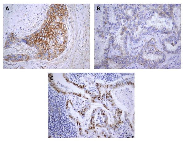 Localization of Cx43 expression in tumor cells: (A) Combined membranous and cytoplasmic; (B) Cytoplasmic; (C) Nuclear.