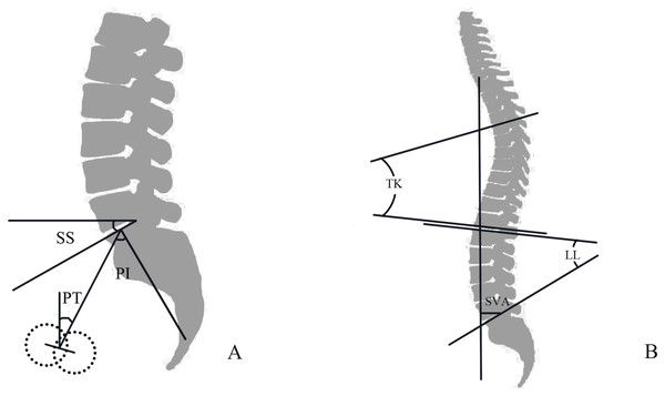 (A) Diagrammatic sketch of PI, Pelvic Incidence angle; PT, pelvic tilt; SS, sacral slope; (B) Diagrammatic sketch of SVA, sagittal vertical axis; TK, thoracic kyphosis; LL, lumbar lordosis.