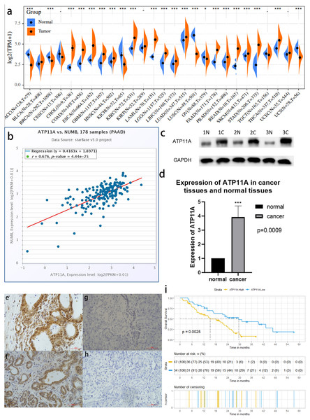 ATP11A is highly expressed in pancreatic cancer tissues and is associated with poor prognosis.