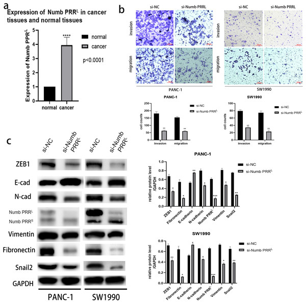 Numb PRRL is important for maintaining the aggressive pancreatic cancer cell phenotype and EMT.