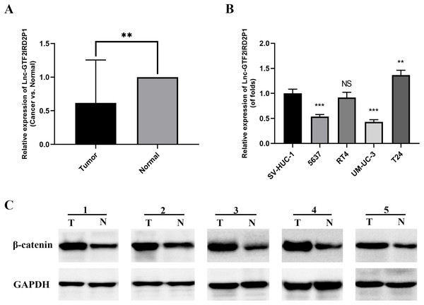 Expression of GTF2IRD2P1 and Wnt pathway proteins in BCa tissues.