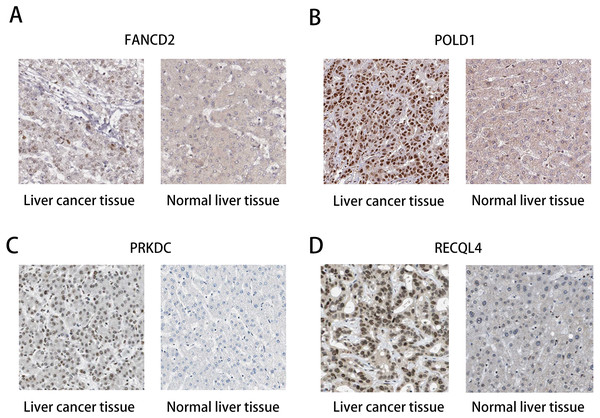 Immunohistochemistry (HPA): expression of PRKDC, FANCD2, POLD1 and RECQL4 in HCC and normal tissues.