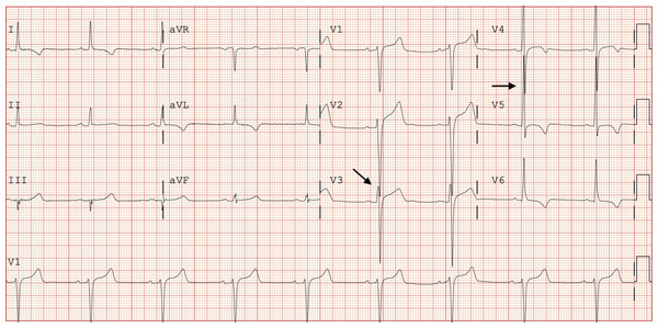 Standard 12-lead electrocardiogram demonstrating Seamens’ Sign with precordial QRS complexes overlapping and/or touching.