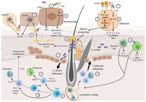 Inflammatory process in acne pathogenesis.