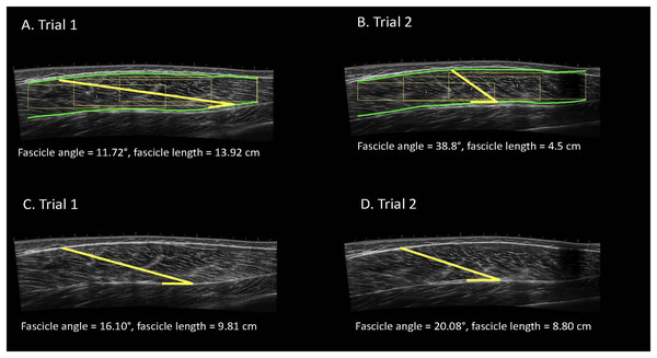 Examples of automatic (A, B) and manual (C, D) analyses of the vastus lateralis completed by the same analyst for the same participant with the image taken at a higher frequency.
