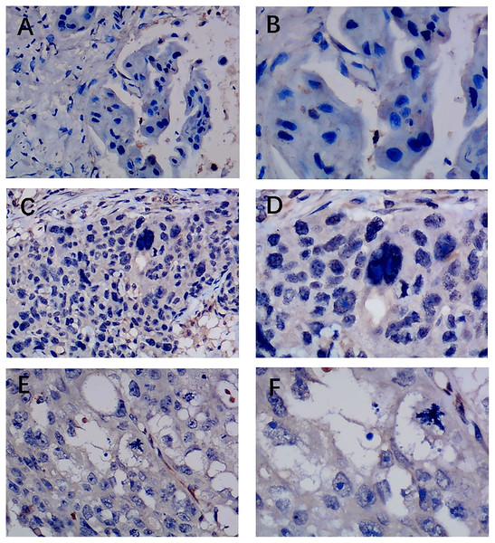 Immunohistochemistry staining of EZH1 in triple-negative breast cancer (TNBC).