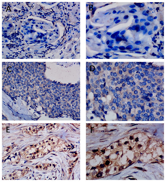 Immunohistochemistry staining of EZH1 in non-triple-negative breast cancer (non-TNBC).