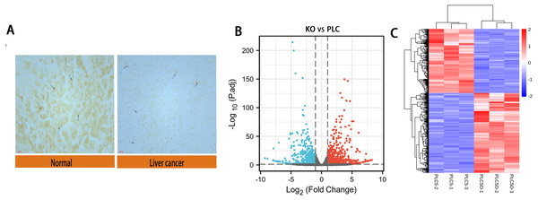 Differential expression of DAPK1 and volcano plot and heat maps of differential genes.