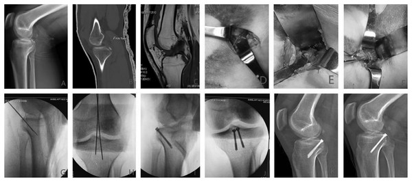 Preoperative, intraoperative and postoperative images.