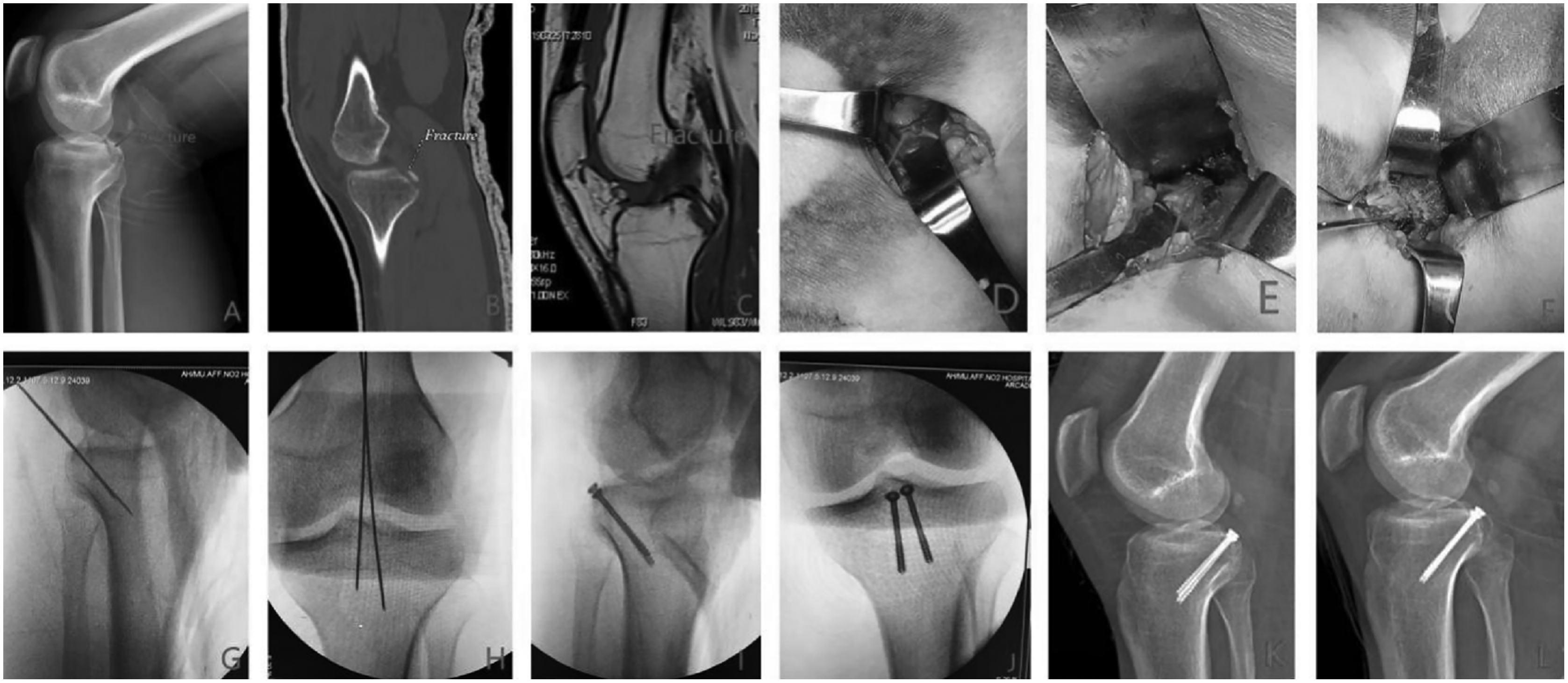 Minimally invasive versus traditional inverted “L” approach for