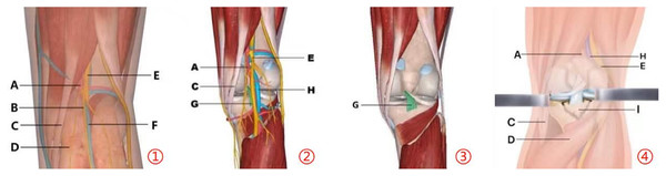 Surgical anatomical illustration of PCL avulsion fracture of tibial insertion.
