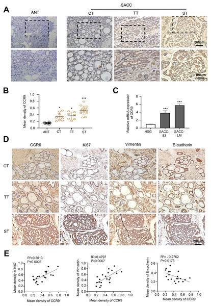Expression of CCR9 in SACC and its correlation with tumor proliferation and metastasis.