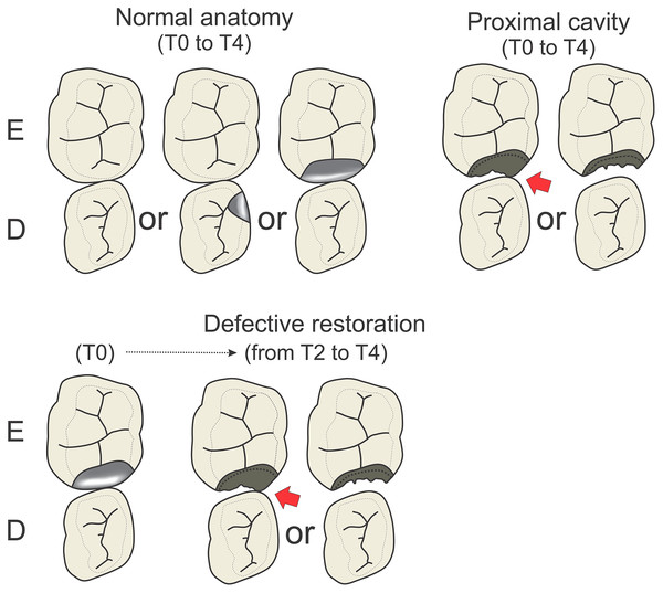 Illustration showing different “status of the proximal surface”, grouped into normal anatomy, defective restoration and proximal cavity.