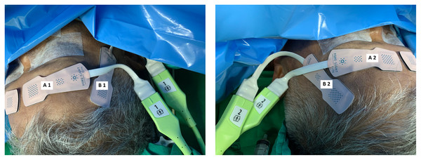 Locations of two pairs of ForeSight sensors.