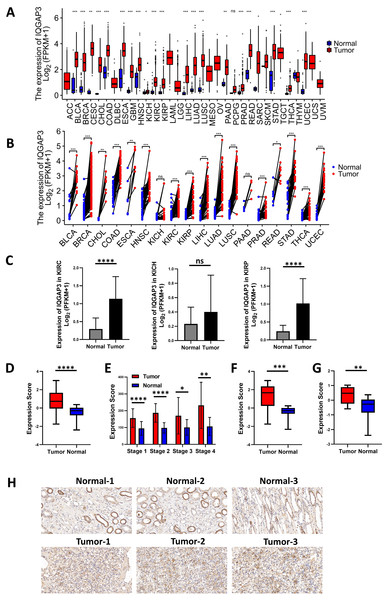 IQGAP3 expression was increased in cancer than normal tissues.