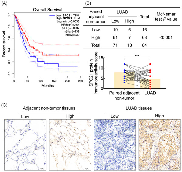 SPC21 expression analysis in lung adenocarcinoma (LUAD).
