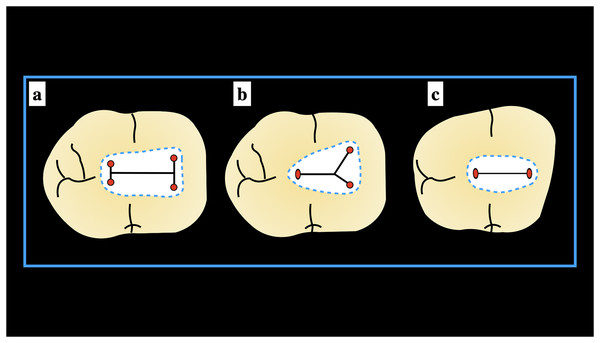 Schematic presentation of the Pawar and Singh classification© for mandibular molars (A) “H” type, (B) “Y” type, and (C) “I” type.