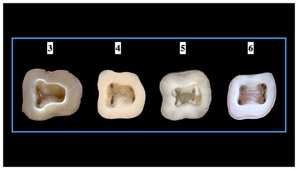 Number of root canal orifices seen in mandibular first molars.