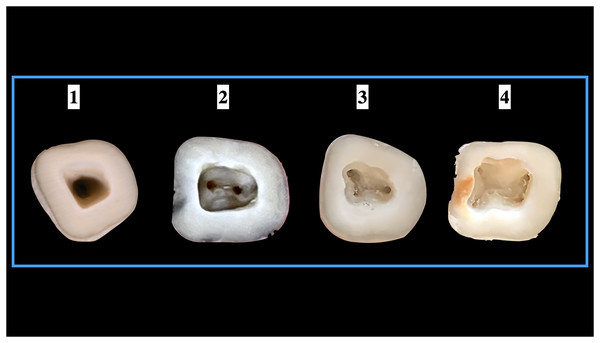 Number of root canal orifices seen in mandibular second molars.