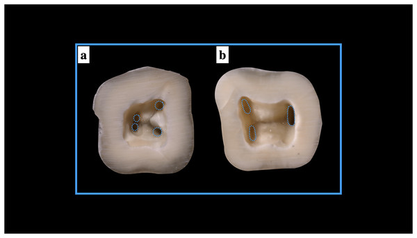 Shapes of the root canal orifices (A) round root canal orifices, (B) oval root canal orifices.