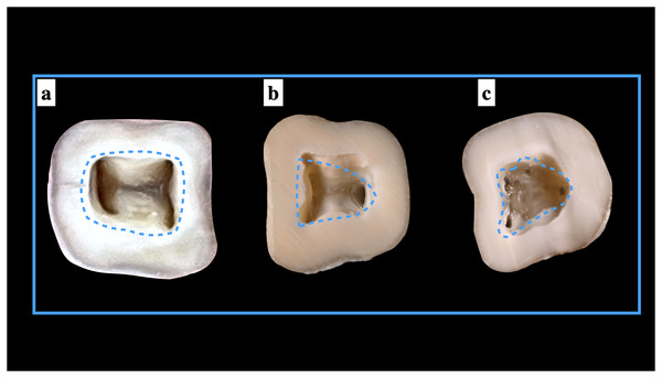 Shape of the pulp access cavities.