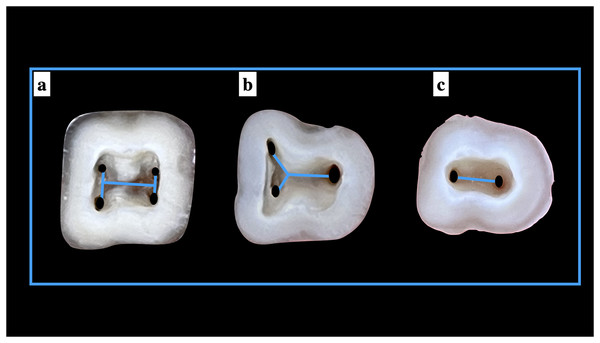 Shape of the root canal orifices anatomy according to Pawar and Singh classification (A) “H” type, (B) “Y” type, and (C) “I” type.