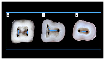 The morphology of the pulp chamber floor of permanent mandibular first ...