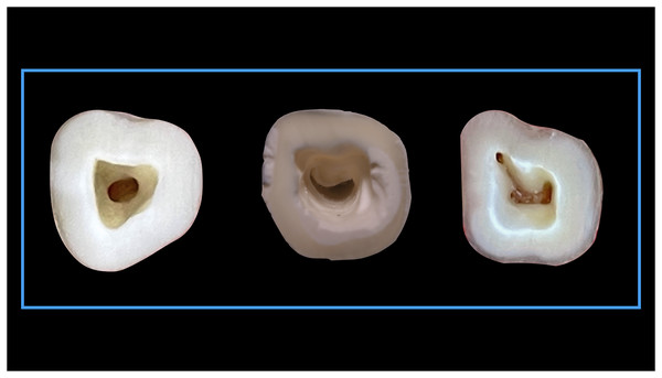 Shape of the root canal orifices anatomy according to Pawar and Singh classification “Others” type.