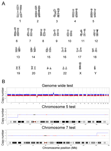 Karyotyping and CNV-seq results of case 39.