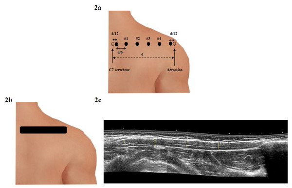 Evaluation of stiffness and thickness of the upper trapezius muscle: (A) Reference points and locations including four points for measuring the upper trapezius muscle stiffness according to Kisilewicz et al. (2020). In this figure “d” indicates the distance between the spinous process of the C7 vertebra and acromion, while “d/12” is “d” divided by 12; “d/6” is “d” divided by 6; (B) ultrasound measurement of the upper trapezius muscle thickness on the long axis, including the measure in four reference points; (C) ultrasound transducer position to the muscle fibers located of the C7 vertebra.