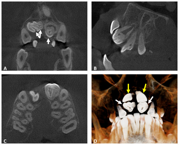 Coronal, sagittal, axial, and cross-sectional CBCT images that are examined.