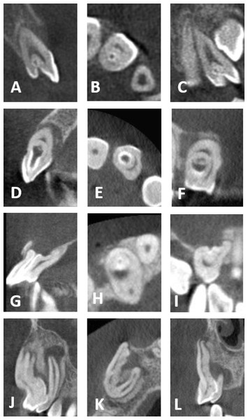 CBCT images of the four DI types.
