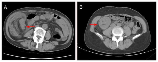 (A) CT at the level of the abdomen shows ileocecal intussusception (arrow). (B) CT at the level of the abdomen shows a round, target-shaped mass in the right abdomen (arrow).
